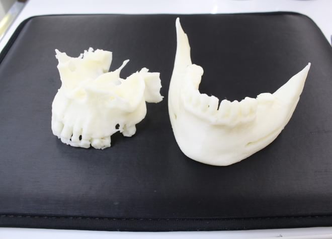 歯科用CTと3D生体造形モデルを駆使したインプラント治療