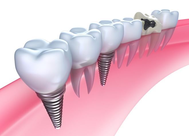 入れ歯やブリッジと違って、健康な歯に負担がかからない。それがインプラントの特徴です。