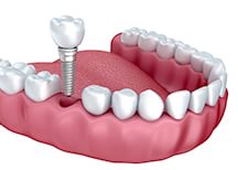 失った歯の機能を再び取り戻したいという方のためにインプラント治療があります