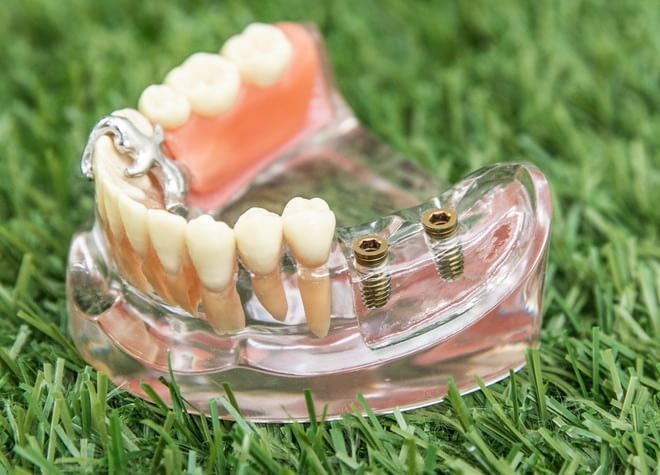 せっかく入れたインプラントが歯周病によって破壊されるのを防ぐため、治療後も定期的な通院をおすすめします
