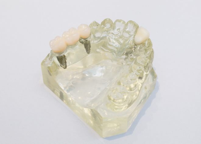 【入れ歯】インプラントに力を入れている歯科医師が入れ歯治療を行います