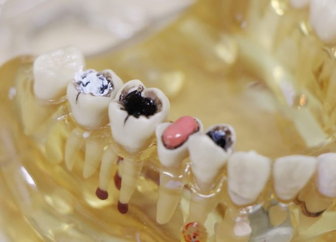 Q.虫歯の治療を行う上で大切にしていることはありますか？