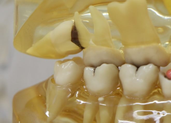 Q.抜歯を行う際に心がけていることはありますか？
