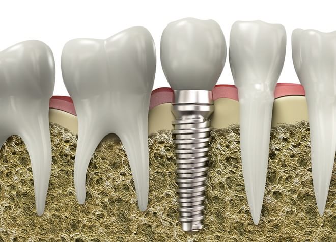 歯科口腔外科（親知らず・インプラント治療・顎関節症）について～複雑な技術が求められる歯科口腔外科～
