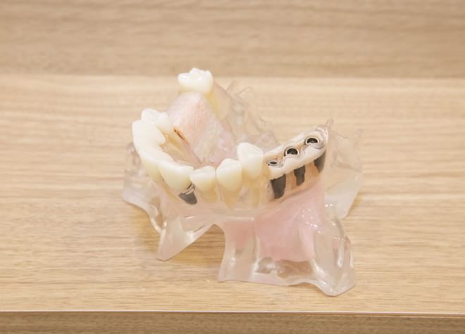 Q.入れ歯治療で大切にしていることは何ですか？