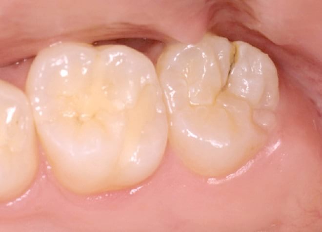 初期の虫歯は短時間の保険診療で治ります。早期発見・早期治療が大切です