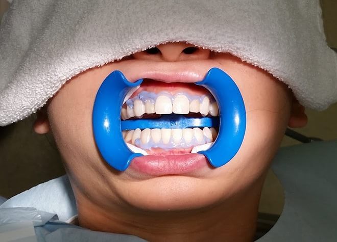 【自由診療】もっと白い歯をお望みなら、ホワイトニングをお奨めします。