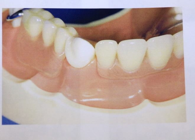 入れ歯・義歯は患者さまのお口のなかに入れてからが治療開始