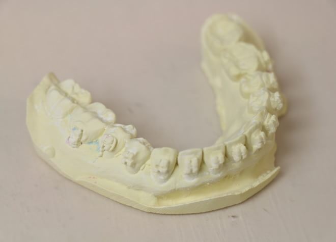 歯並びを整えることは、見映えだけでなく、大切な歯を残していくことにつながります