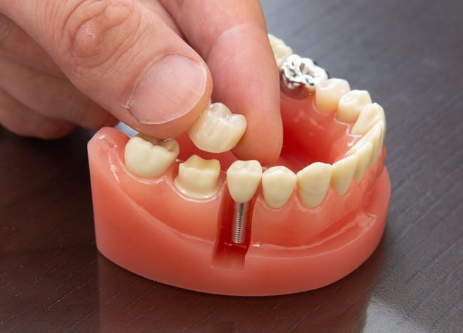 失った歯を補うためではなく、残った歯を守るためのインプラント治療を提案しています