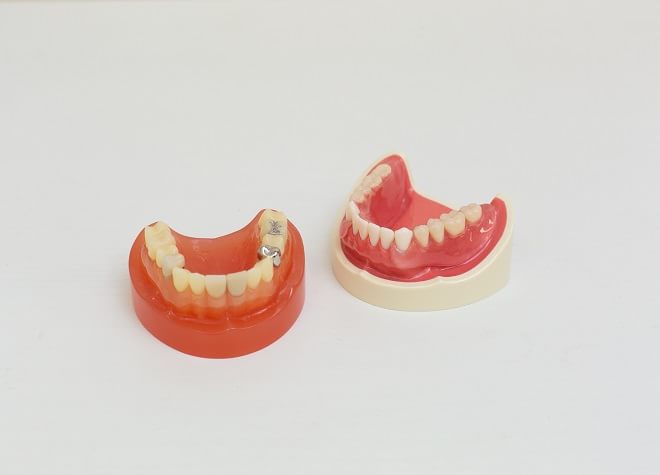 入れ歯を作製する際に大切なのは型取りだと考えます