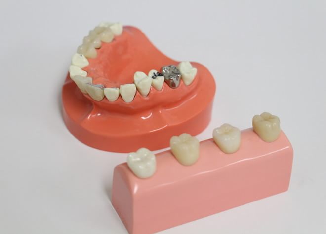 患者さまの大切な歯を守るため、再発しないよう丁寧な詰め物・被せ物治療を行います